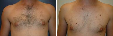 epilace hrudník před a po | Epilace - Před a po